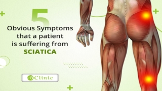 5 Symptoms of Sciatica a Stockport Chiropractor can treat