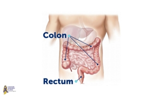 Treatment For Colorectal Cancer in Mumbai