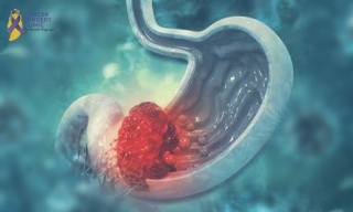 Top Gastric Cancer Treatments Doctor in Mumbai