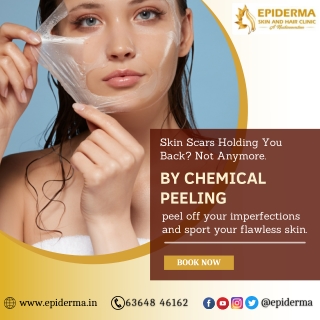 Best Chemical peeling Treatment in Jayanagar - Epiderma Clinic