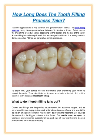 How Long Does The Tooth Filling Process Take