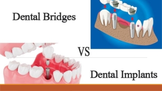 DENTAL IMPLANTS VS BRIDGE WHICH IS BETTER