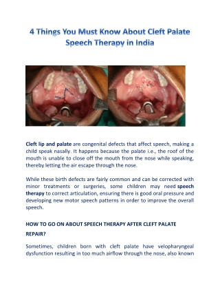 4 Things You Must Know About Cleft Palate Speech Therapy in India