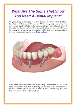 What Are The Signs That Show You Need A Dental Implant