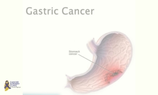 Doctor For Gastric Cancer Treatments in Mumbai