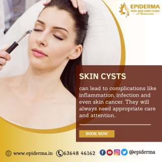 Skin Cysts | Best Dermatology Center in Jayanagar | Epiderma Clinic