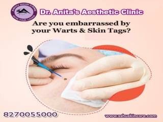 india's Best  laser wart and skin tag remove treatment clinic in bhubaneswar, odisha