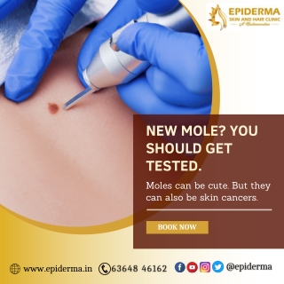 Mole Excision | Best Dermatology Centre in Jayanagar | Epiderma Clinic