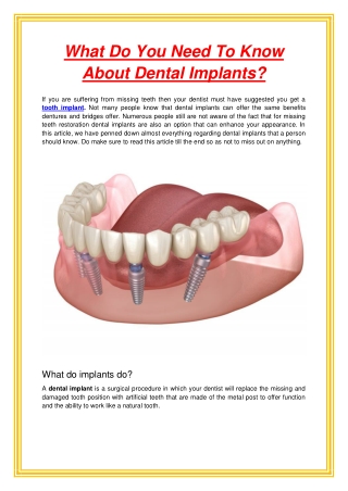 What Do You Need To Know About Dental Implants