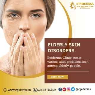 Elderly Skin Disorders - Best Dermatology Centre in Jayanagar - Epiderma Clinic