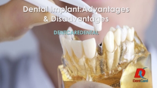 Dental Implant Advantages and Disadvantages