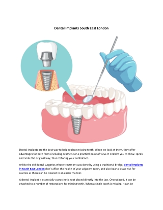 Dental Implants South East London