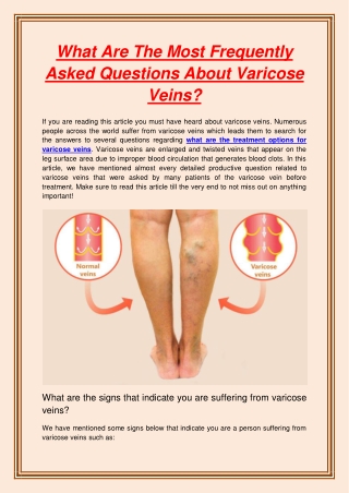 What Are The Most Frequently Asked Questions About Varicose Veins