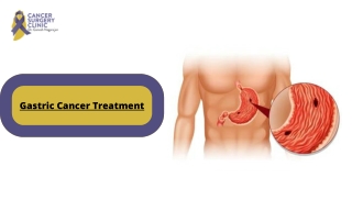 CancerSurgeryClinic For Gastric Cancer Treatments