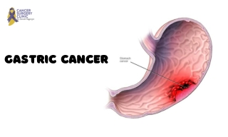 Best Cancer Doctor For Gastric Cancer Treatment