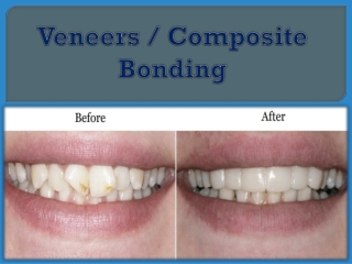 Veneers  Composite Bonding
