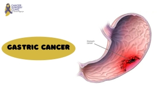 Surgeon Doctor For Gastric Cancer Treatments