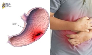 Best Cancer Hospital For Gastric Cancer Treatments