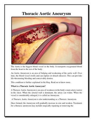 Thoracic Aortic Aneurysm