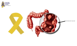 Cancer Surgery For Colorectal Cancer Treatment