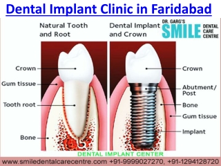 Best Dental Implant Clinic in Faridabad Experienced Surgeon