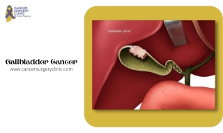 Doctor For Gallbladder Cancer Treatment in Mumbai