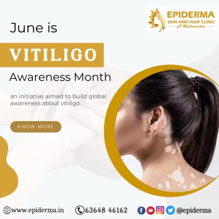 June is Vitiligo Awareness Month | Best Dermatologist in Jayanagar | Epiderma