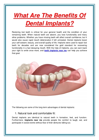 What Are The Benefits Of Dental Implants