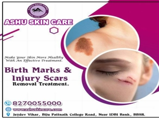 ashu skin care is one of the best for birth marks and injury marks removal treatment clinic in bhubaneswar, odisha