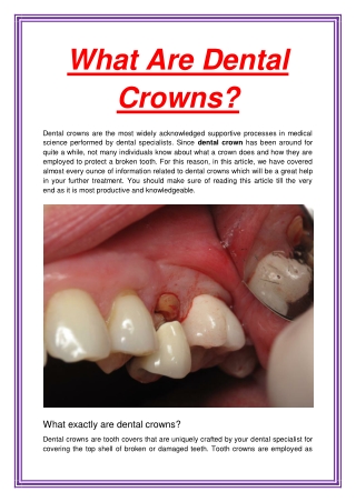 What Are Dental Crowns