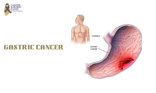 Famous Doctor For Gastric Cancer Treatments