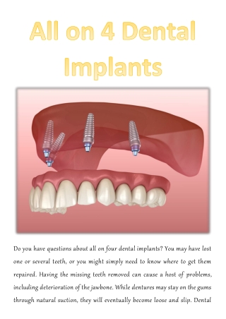 All on 4 Dental Implants