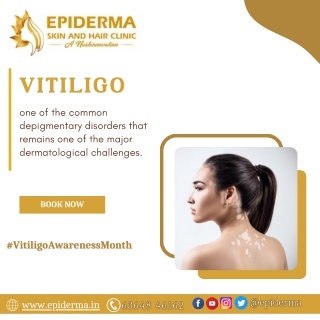 Vitiligo Facts | Best Skin Clinic in Jayanagar | Epiderma Clinic