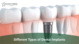 Different Types of Dental Implants