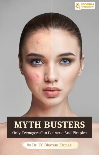 Myth busters on Acne And Pimples - Best Skin Clinic in Jayanagar - Epiderma Clinic