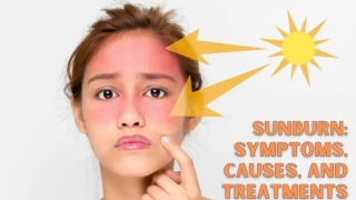 SUNBURN SYMPTOMS, CAUSES, AND TREATMENTS