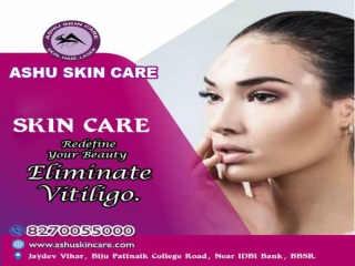 ashu skin care is best for vitiligo treatment in bhubaneswar, odisha