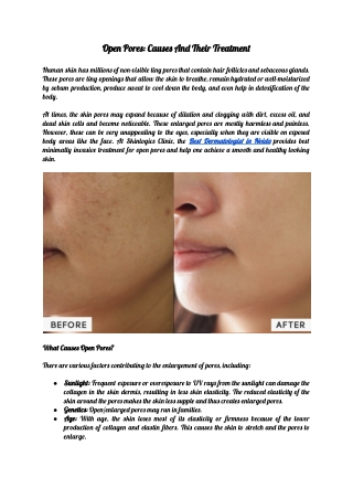Open Pores: Causes And Their Treatment