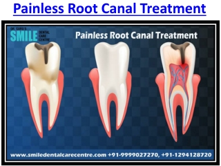 Dental Clinic in Faridabad For Painless Root Canal Treatment