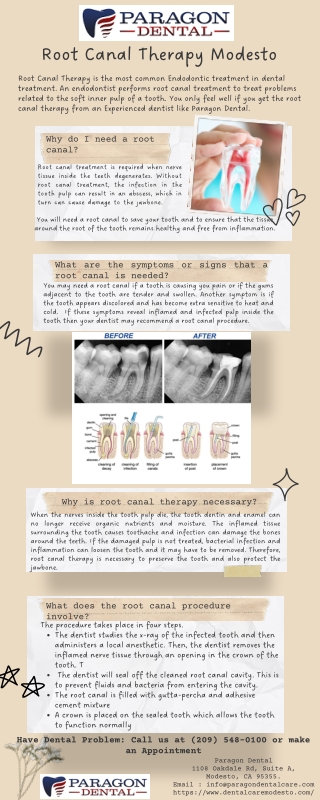 Root Canal Therapy Modesto