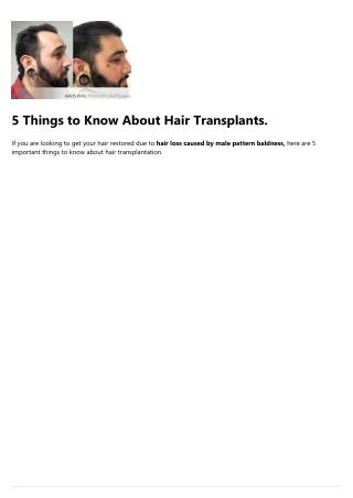 Hair Transplant Reviews