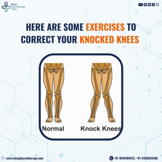 What is Knck knees - Balaji Physiotherapy Clinic Noida