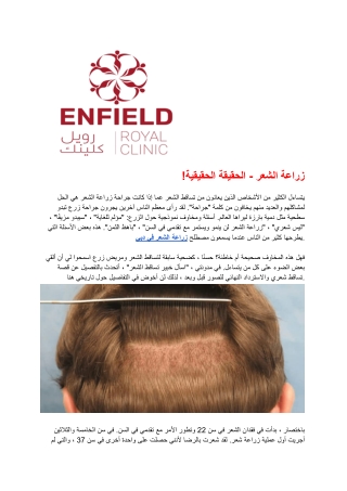 زراعة الشعر - الحقيقة الحقيقية!