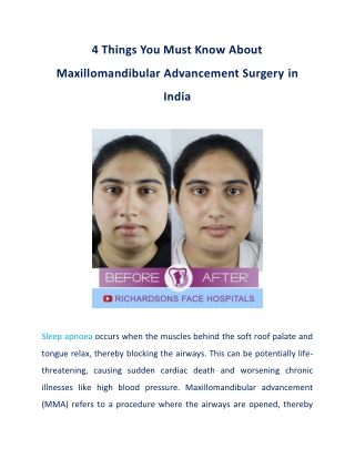 All You Must Know About Maxillomandibular Advancement Surgery in India