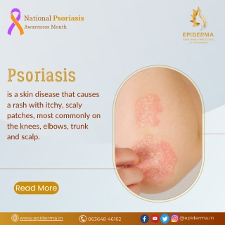 Psoriasis | Best Dermatology Centre in Jayanagar | Epiderma Clinic