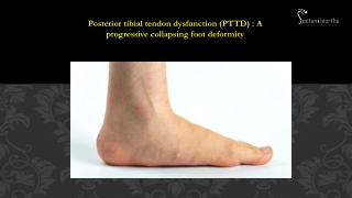 Posterior tibial tendon dysfunction (PTTD) Footankleortho.