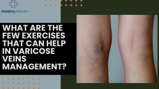 varicose veins