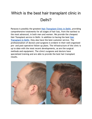 Which is the Best Hair Transplant Clinic in Delhi