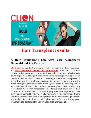 Hair Transplant results