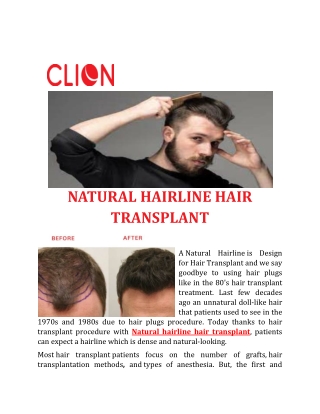 NATURAL HAIRLINE  TRANSPLANT